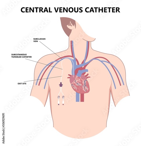 PICC Line insert neck tube vein arm blood draws heart IV needle cancer therapy Total peripheral internal double lumen chest port fluid injection large artery superior vena cava care drug implantation