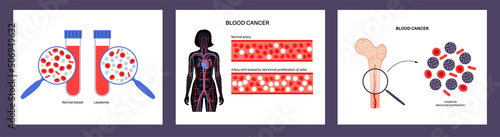 leukemia blood cancer