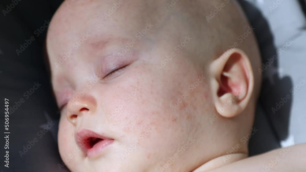 atopic dermatitis rush and allergic skin on baby infant cheek face ...