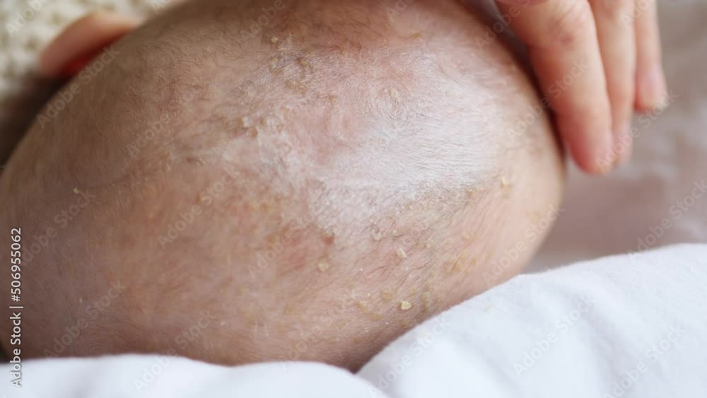 applying cream moisturizer on seborrheic dermatitis newborn baby's head