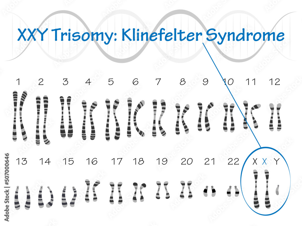 Klinefelter Syndrome Karyotype Stock Vector | Adobe Stock