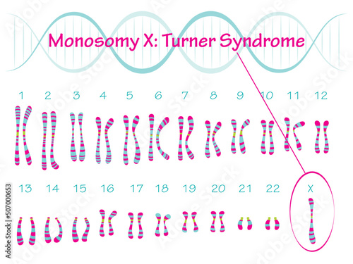Monosomy X: Turner Syndrome Karyotype