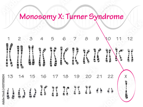 Monosomy X: Turner Syndrome Karyotype photo