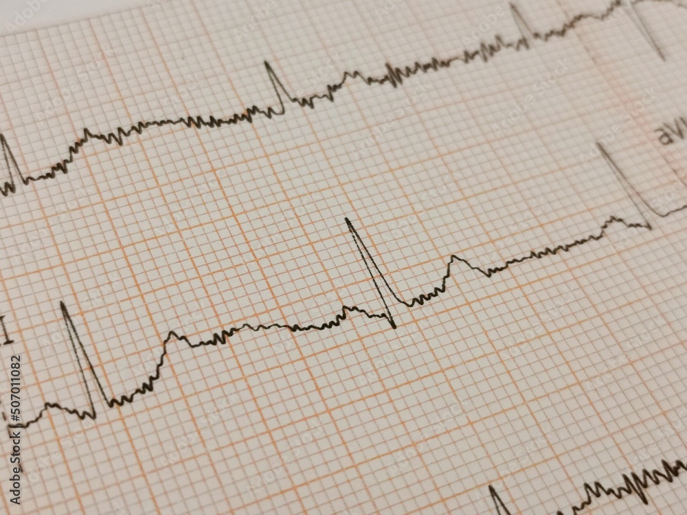ecg graph on ecg