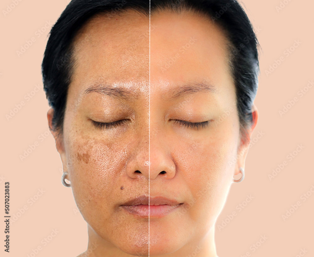 Image before and after spot melasma pigmentation facial treatment on