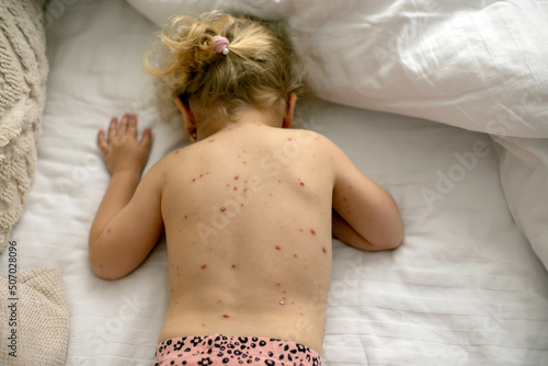 Little toddler girl with chicken pox in bed, playing at home, quarantine isolation