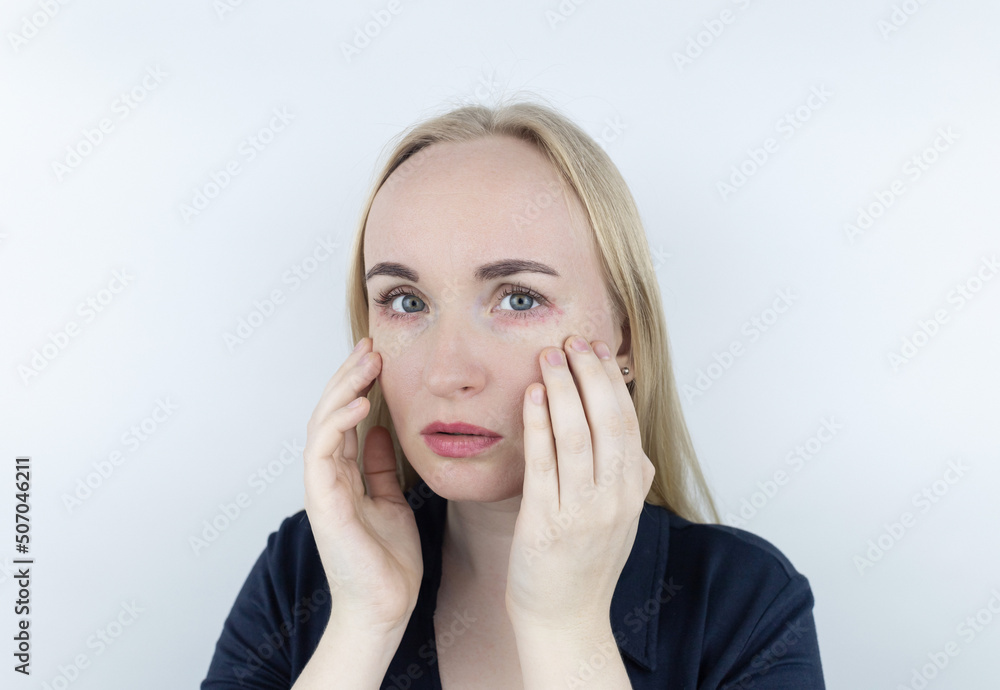 Allergy to cosmetics. The girl looks at the pimples around her eyes that appeared after using toxic cosmetics. Red spots on woman skin Allergy to cosmetics. The girl looks at the pimples around her eyes that appeared after using toxic cosmetics. Red spots on woman skin