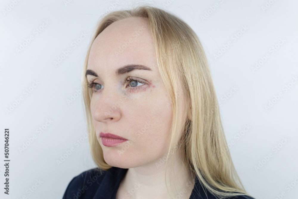 Allergy to cosmetics. The girl looks at the pimples around her eyes that appeared after using toxic cosmetics. Red spots on woman skin Allergy to cosmetics. The girl looks at the pimples around her eyes that appeared after using toxic cosmetics. Red spots on woman skin