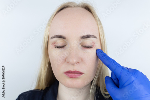 Allergy to cosmetics. The girl looks at the pimples around her eyes that appeared after using toxic cosmetics. Red spots on woman skin
