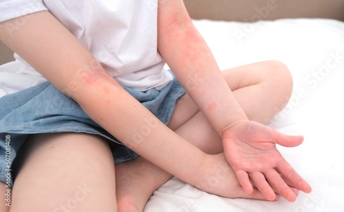 The child scratches atopic skin. The child applies a special cream to atopic skin. Dermatitis  diathesis  allergy on the child s body.  