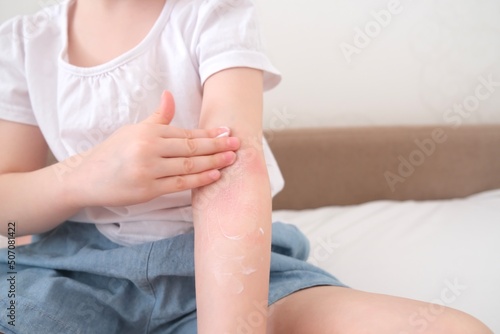 The child scratches atopic skin. The child applies a special cream to atopic skin. Dermatitis, diathesis, allergy on the child's body.	
 photo