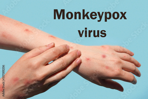 Phrase MONKEYPOX VIRUS on blue background and Patient with Monkey Pox. Monkeypox new disease dangerous over the world. Painful rash, red spots blisters. Close up human hands with Health problem