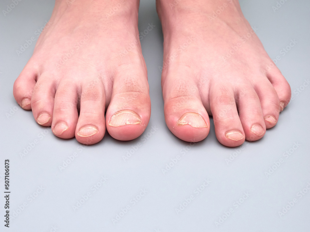Toenails of a 9 year old boy with a nail disease, very weak or brittle
