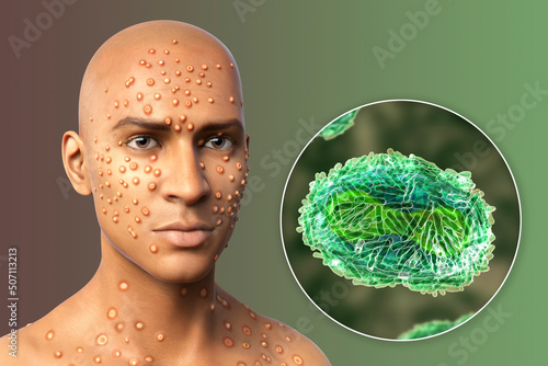 Patient with monkeypox and close-up view of monkeypox virus, 3D illustration photo