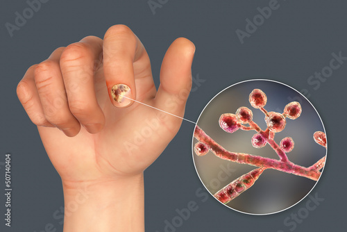 Human hand with onychomycosis photo