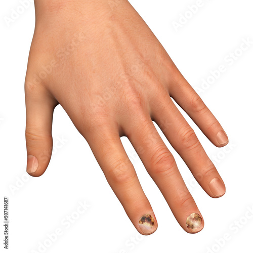 Human hand with onychomycosis photo