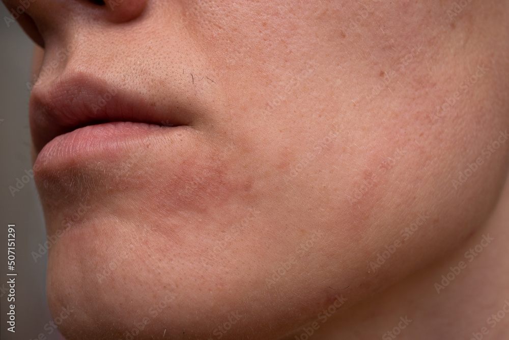 Close up of cheek bone with allergy and mustache Close up of cheek bone with allergy and mustache