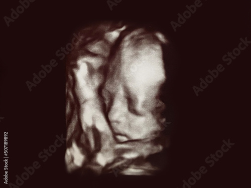 fetal baby ultrasound picture