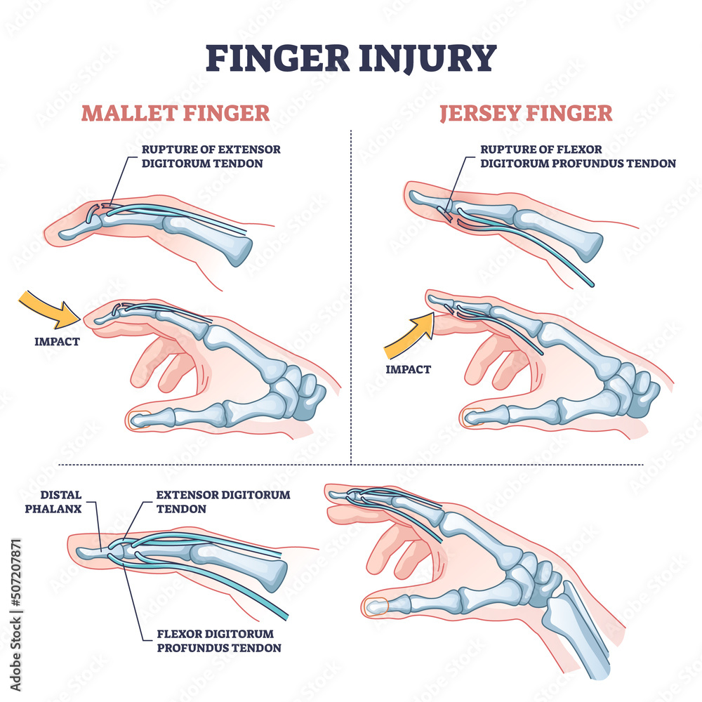 Finger injury types with common hand impact trauma anatomy outline Finger injury types with common hand impact trauma anatomy outline