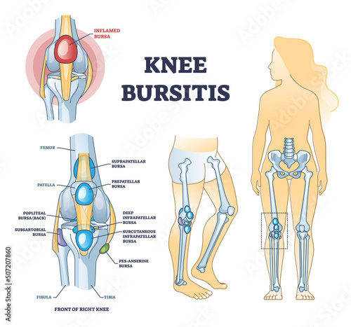 Knee bursitis condition with fluid filled bursa in leg joint outline diagram. Labeled educational medical liquid growth anatomy scheme with chronic leg inflammation pathology vector illustration. photo