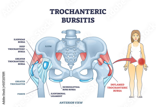 Trochanteric bursitis as bursa inflammation located in hip outline diagram. Labeled educational medical anatomy scheme with iliopsoas and deep greater trochanteric bursa types vector illustration. photo