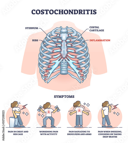 Costochondritis as chest wall pain or costosternal syndrome outline diagram. Labeled educational medical scheme with ribcage cartilage inflammation and painful condition symptoms vector illustration.