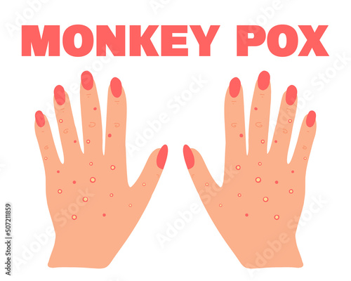 Banner with smallpox monkey. Monkey pox. Hands with a rash. Smallpox symptom. Vector illustration.