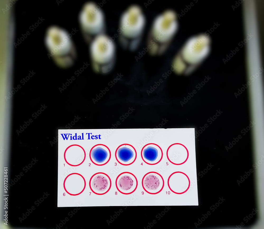 Widal test by agglutination method with lab background, to diagnosis