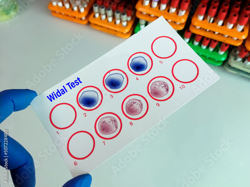 Fotografija Widal test by agglutination method with lab background, to diagnosis Typhoid and Paratyphoid fever at laboratory, Salmonella bacteria disease testing