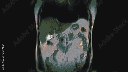 Bulk multicolored CT scan of the abdomen. Computed tomography of the gastrointestinal tract, liver and kidneys