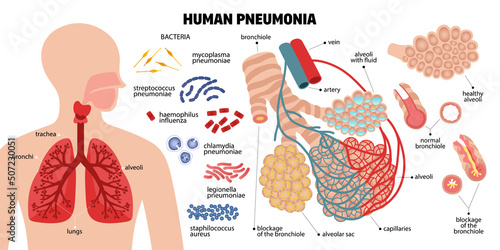 Human Pneumonia Infographic Composition