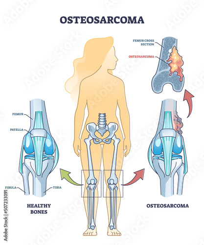 Osteosarcoma bone tumor as osteogenic sarcoma skeleton cancer outline diagram. Labeled educational medical scheme with human knee anatomy or femur cross section vector illustration. Healthy comparison