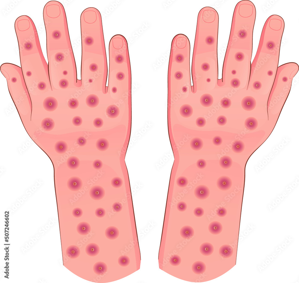 MonkeyPox Hands MonkeyPox Hands