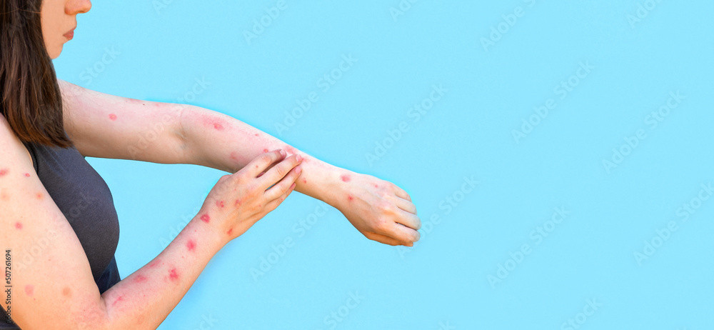 Monkeypox new disease dangerous over the world. Patient with Monkey Pox. Painful rash, red spots blisters on the hand. Close up rash, human hands with Health problem. Banner, copy space - obrazy, fototapety, plakaty 
