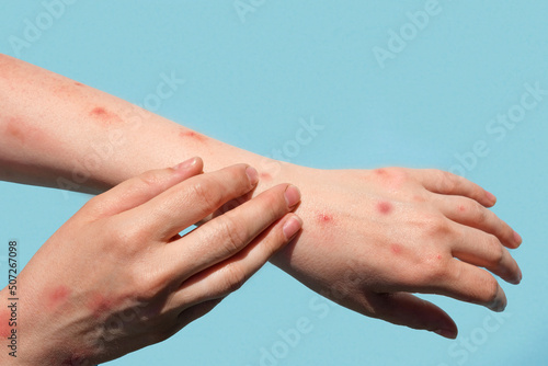 Monkeypox new disease dangerous over the world. Patient with Monkey Pox. Painful rash, red spots blisters on the hand. Close up rash, human hands with Health problem. Banner, copy space. Marv photo