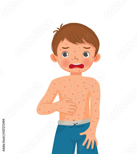 cute little boy scratching his itchy suffering from measles rash allergy skin