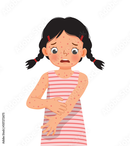 cute little girl scratching her itchy suffering from measles rash allergy skin