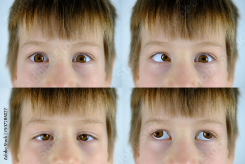 close-up of part of child's face, brown eyes of boy 8-10 years old brown eyes look up, little patient with strabismus, concept of happy childhood, diagnosis, treatment of ophthalmic diseases