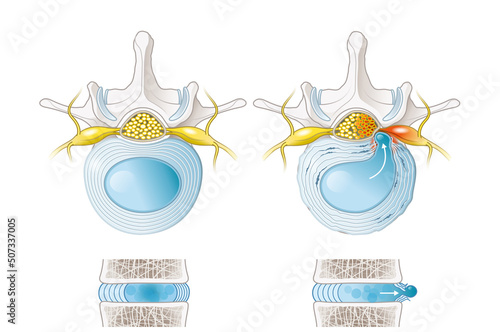 Normal disc and herniated disc, slipped disc, labeled illustration photo