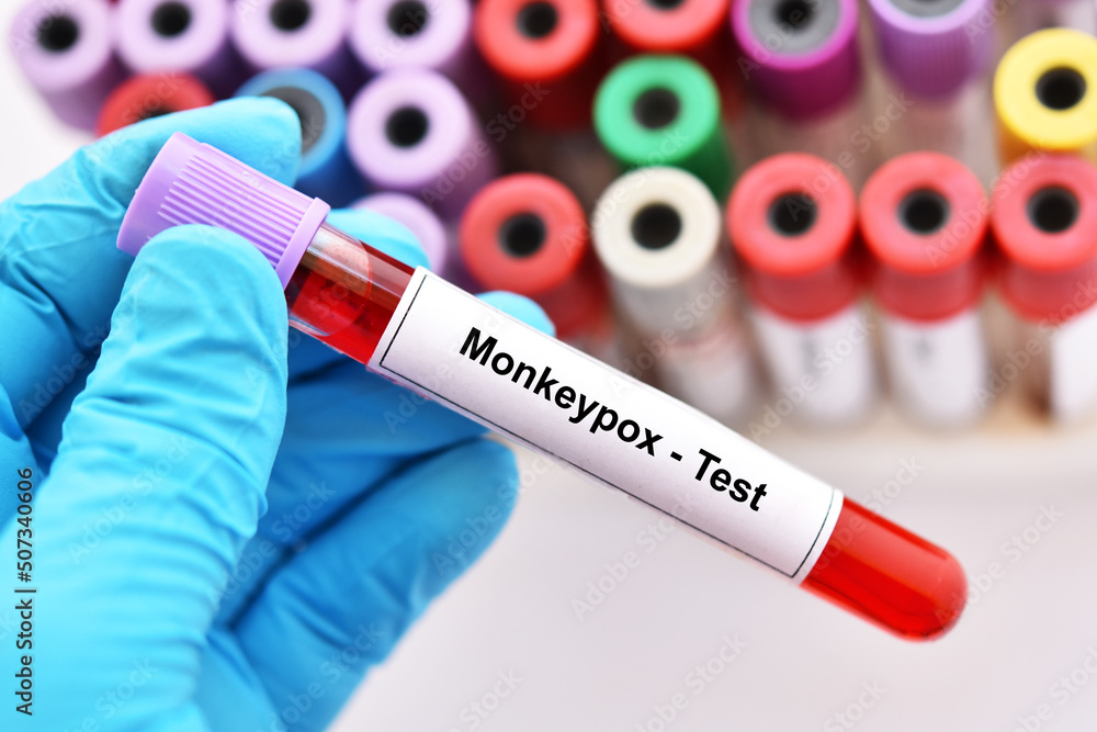 Naklejka premium Blood sample tube for Monkeypox virus test, new epidemic disease in 2022