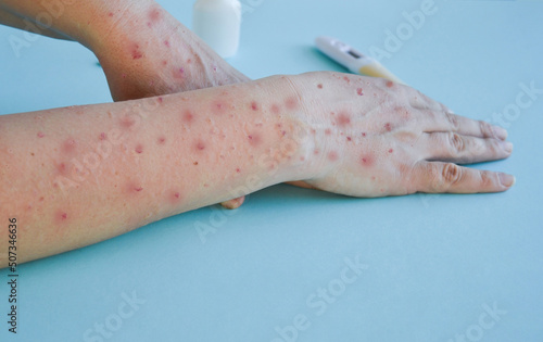 Monkey pox virus, a new world problem of modern humanity. Close-up of the hands of a sick person with pimples and blisters.