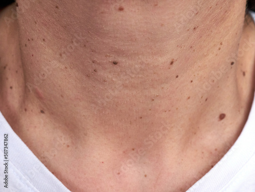 Neck of a woman with many small moles and warts
