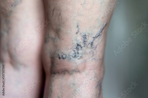 Close up of female leg with extensive varicosity on popliteal region photo