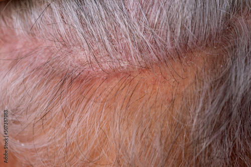 Proriatic plaques in the scalp