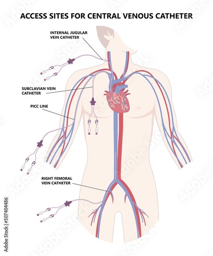 PICC Line insert neck tube vein arm blood draws heart IV needle cancer therapy Total peripheral internal double lumen chest port fluid injection large artery superior vena cava care drug implantation