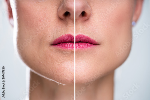 Woman With Before And After Rejuvenation