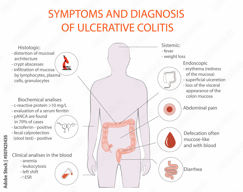 Symptom of ulcerative colitis, vector, medical diagram Stock Vector