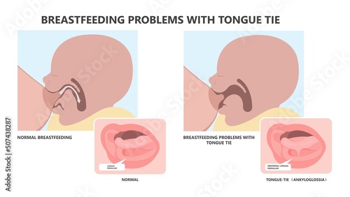 Tongue tie top lip bottle feeding sore damaged nipples issue care nurse Breast oral colic milk supply dentistry Torn frenuloplastika thrust frenulotomy frenulectomy nursery abnormal removal baby photo