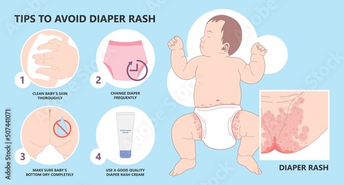 Skin rash allergy hives food cloth staph heat red thrush burn cream bacterial bottom infant newborn child kids wet wear clean thigh treat prevent itchy pain baby oils care home chafe sore leg bleed