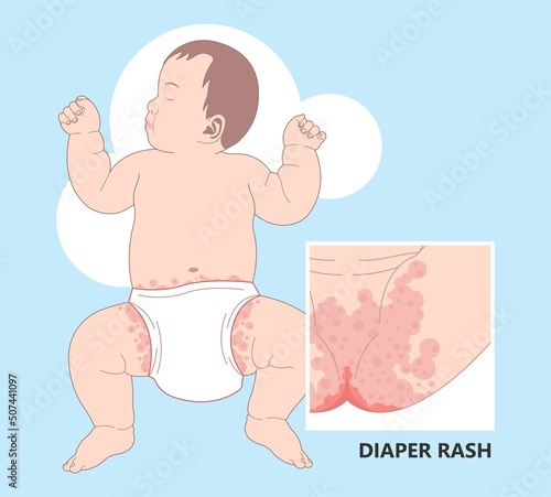 Skin rash allergy hives food cloth staph heat red thrush burn cream bacterial bottom infant newborn child kids wet wear clean thigh treat prevent itchy pain baby oils care home chafe sore leg bleed